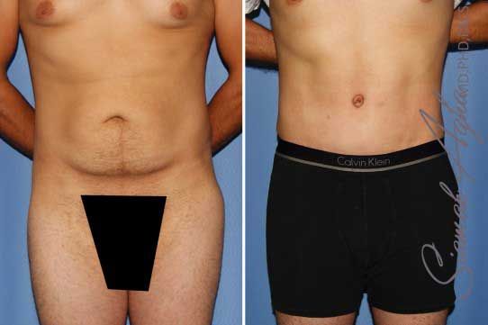 Tummy Tuck Before & After