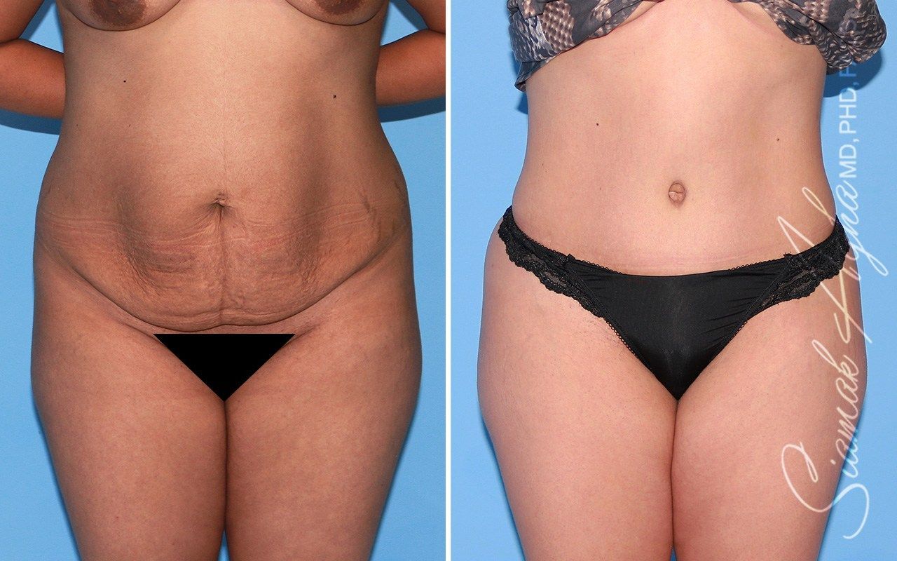 Tummy Tuck Before & After