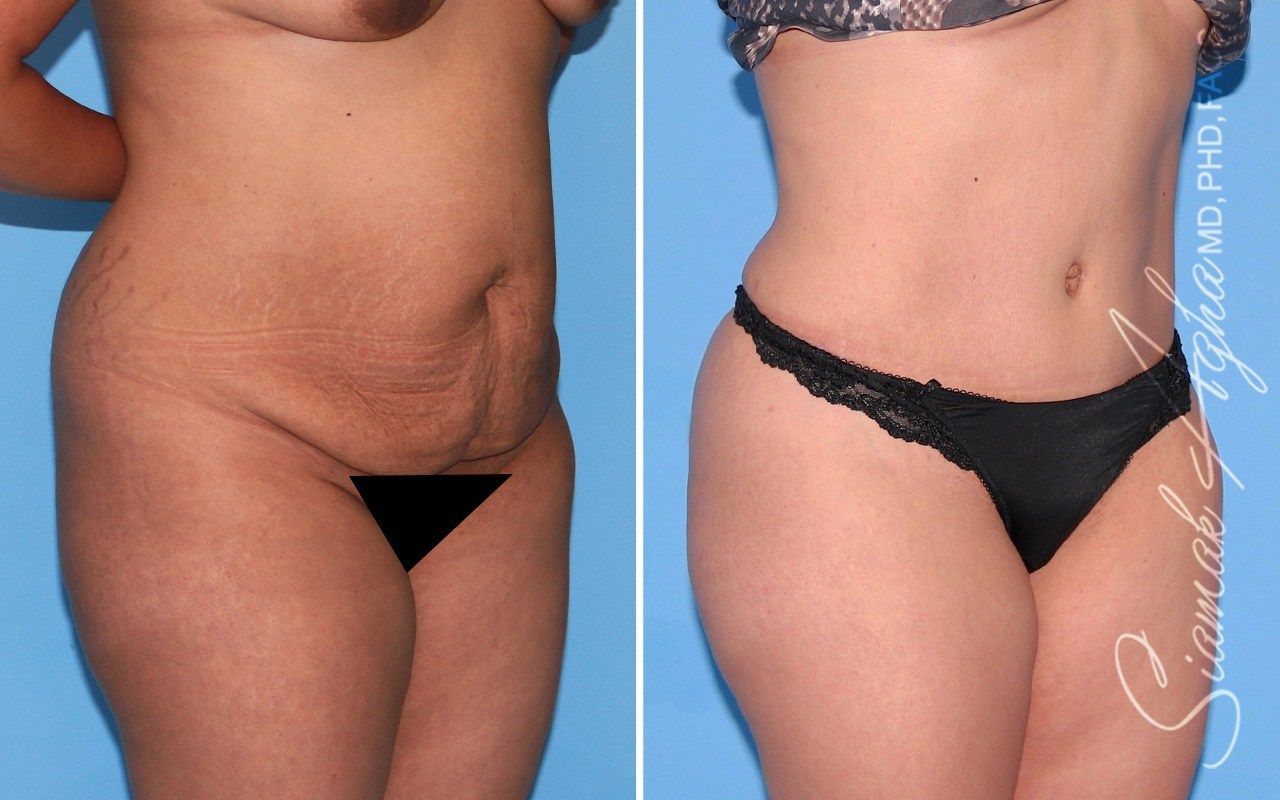 Tummy Tuck Before & After