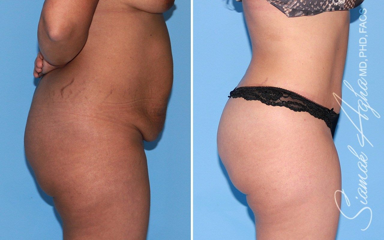 Tummy Tuck Before & After