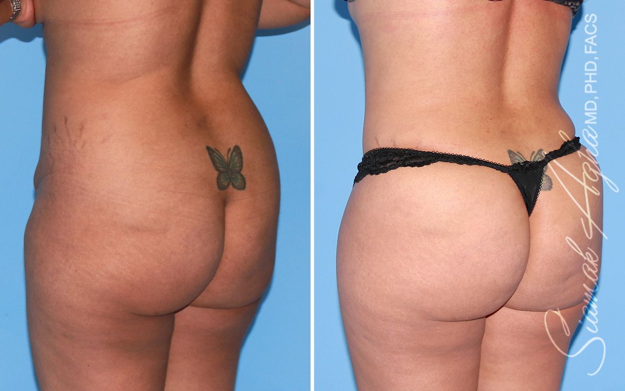 Tummy Tuck Before & After