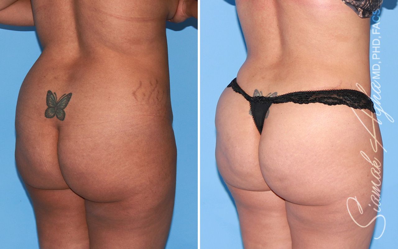 Tummy Tuck Before & After