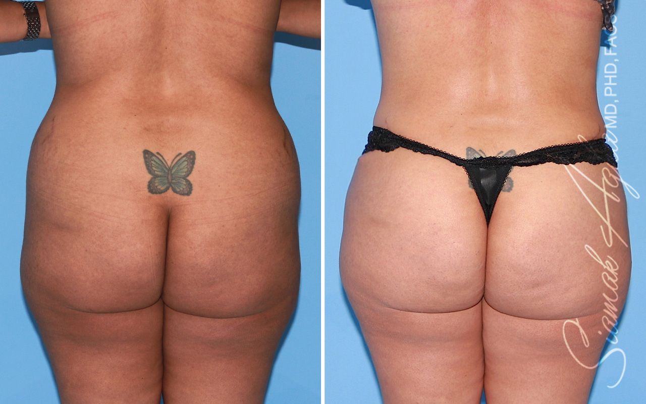 Tummy Tuck Before & After
