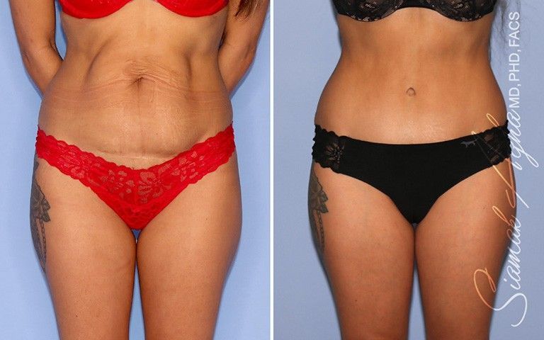 Tummy Tuck Before & After