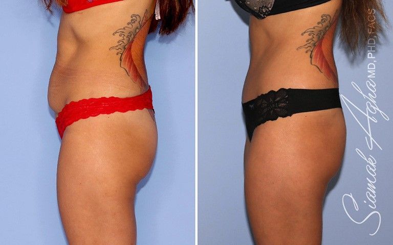 Tummy Tuck Before & After