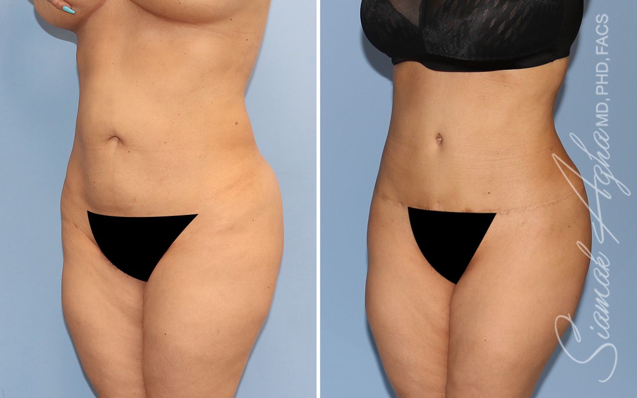 Tummy Tuck Before & After
