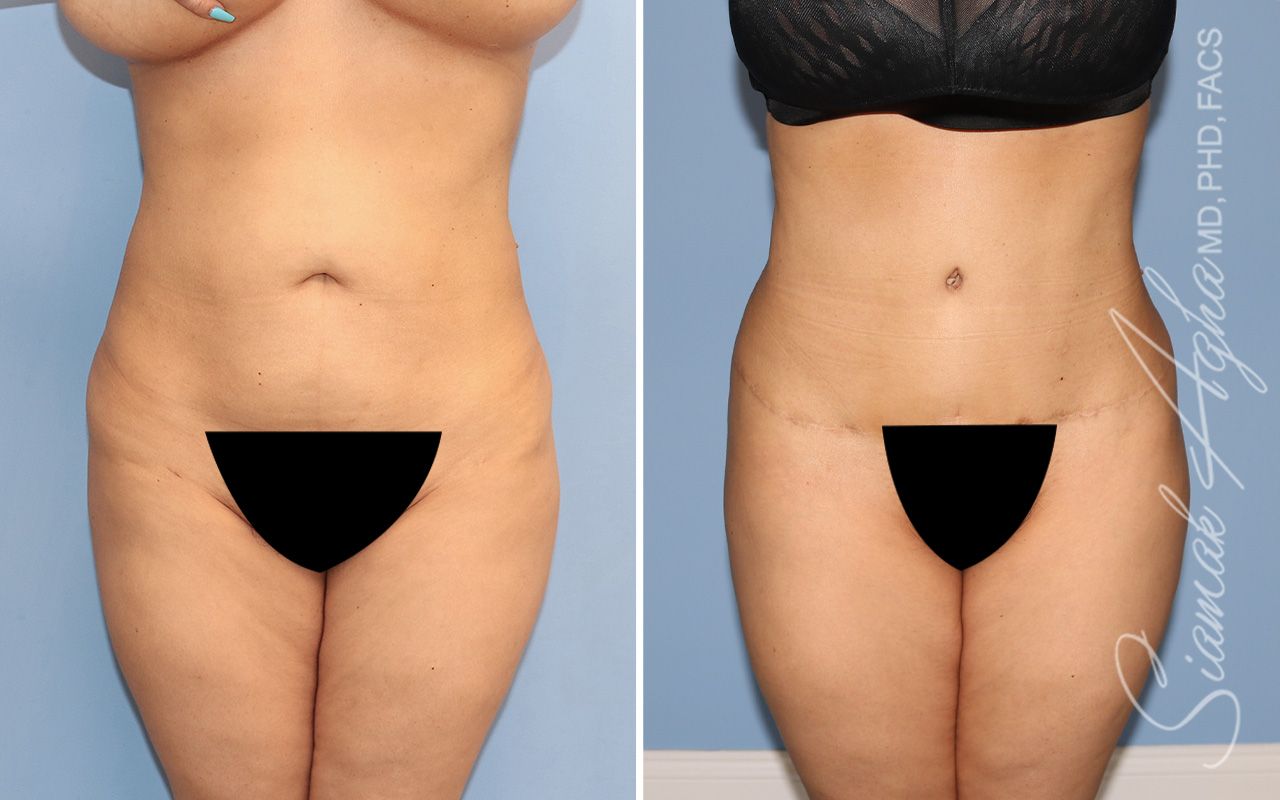 Tummy Tuck Before & After