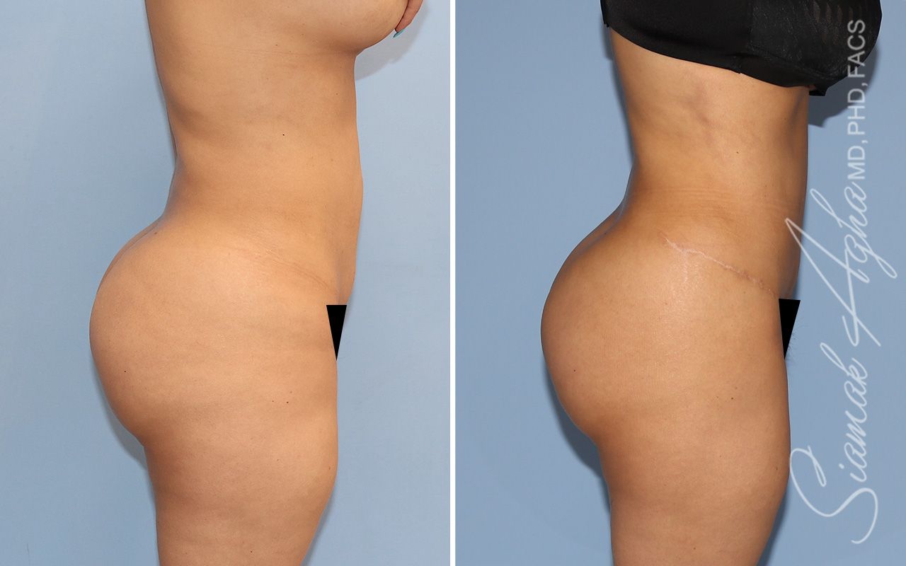 Tummy Tuck Before & After