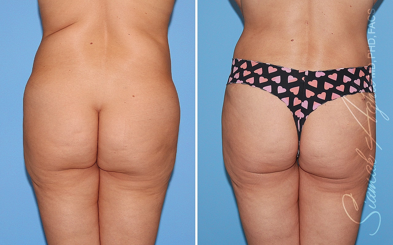Tummy Tuck Before & After