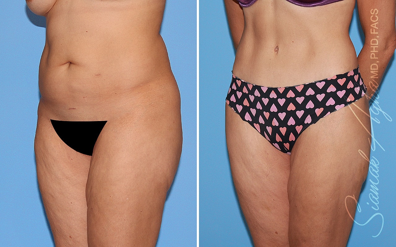 Tummy Tuck Before & After