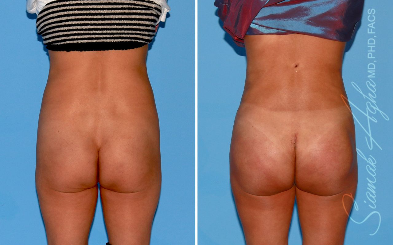 Buttock Implants Before & After