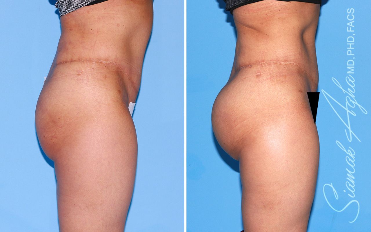 Buttock Implants Before & After