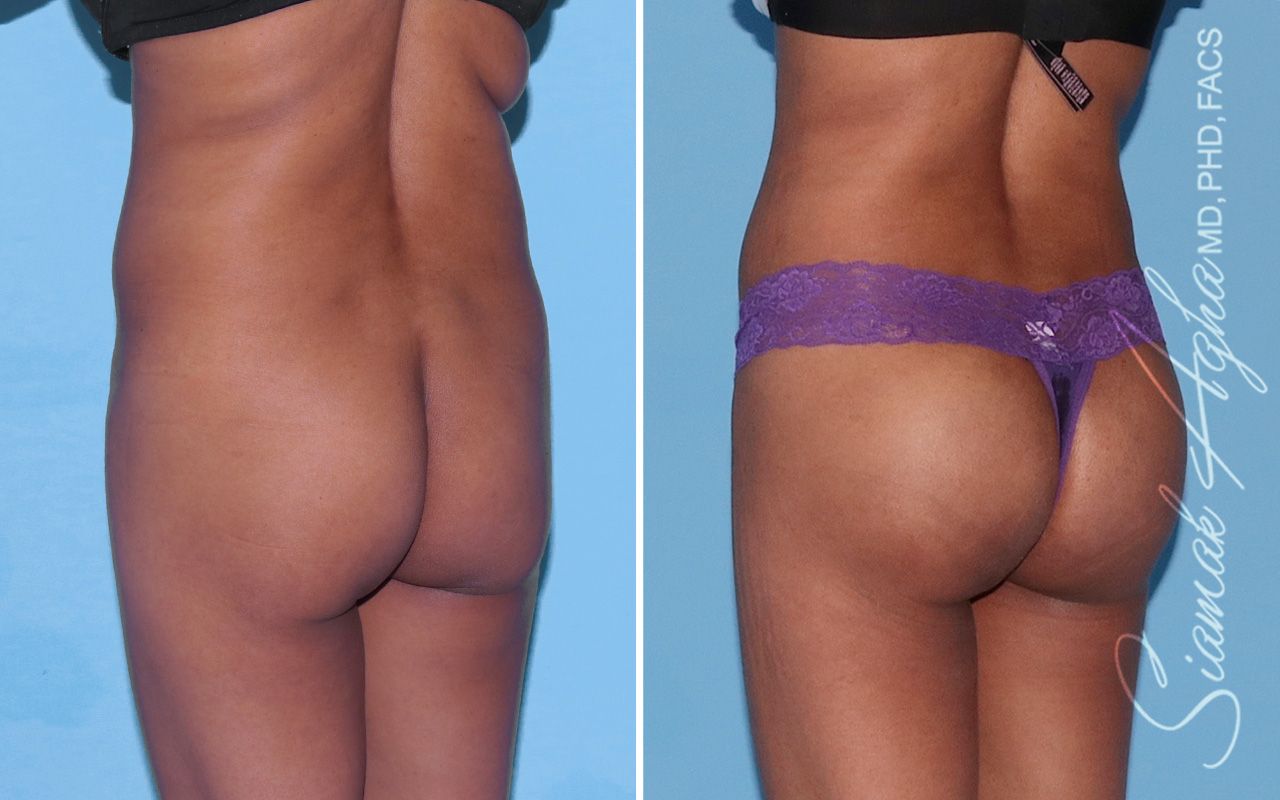 Buttock Implants Before & After