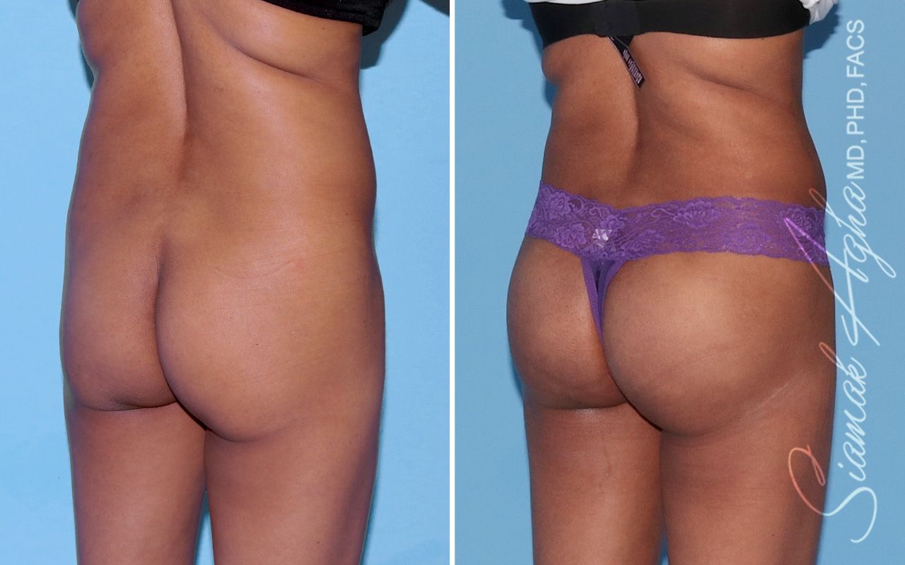 Buttock Implants Before & After