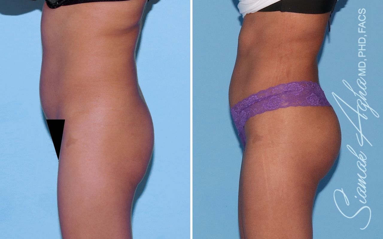 Buttock Implants Before & After