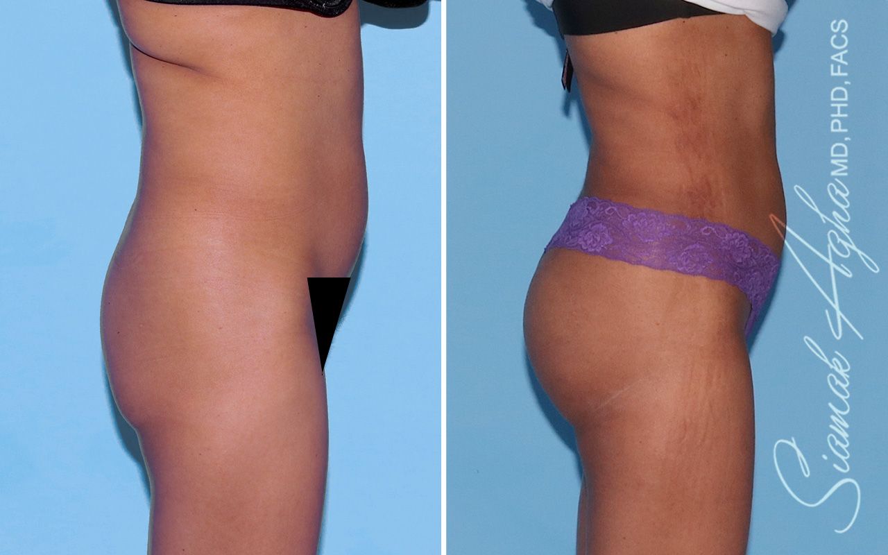 Buttock Implants Before & After
