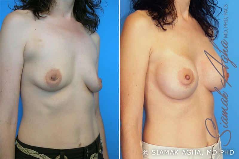 Breast Augmentation Before & After