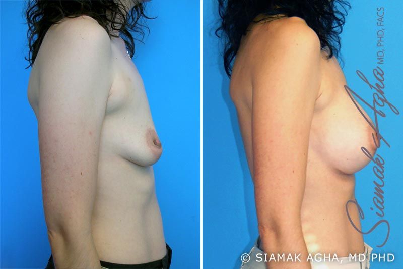 Breast Augmentation Before & After