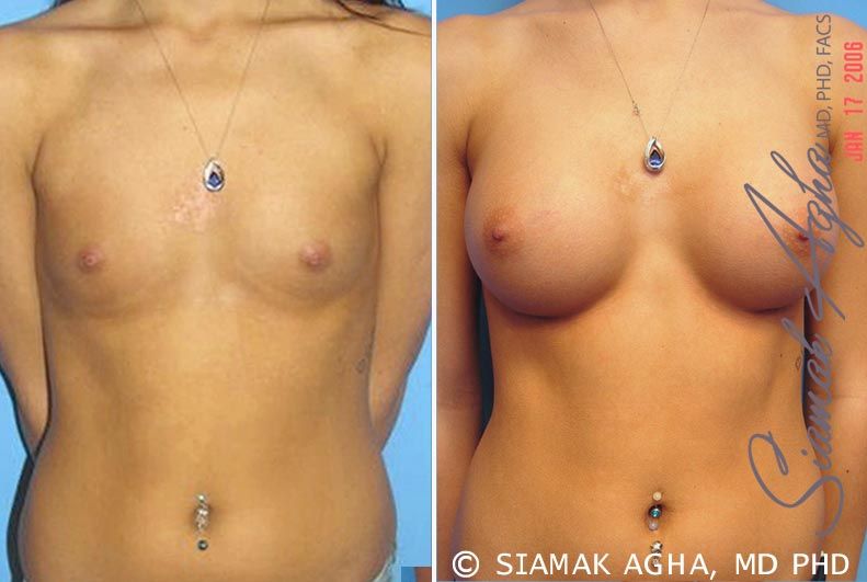 Breast Augmentation Before & After