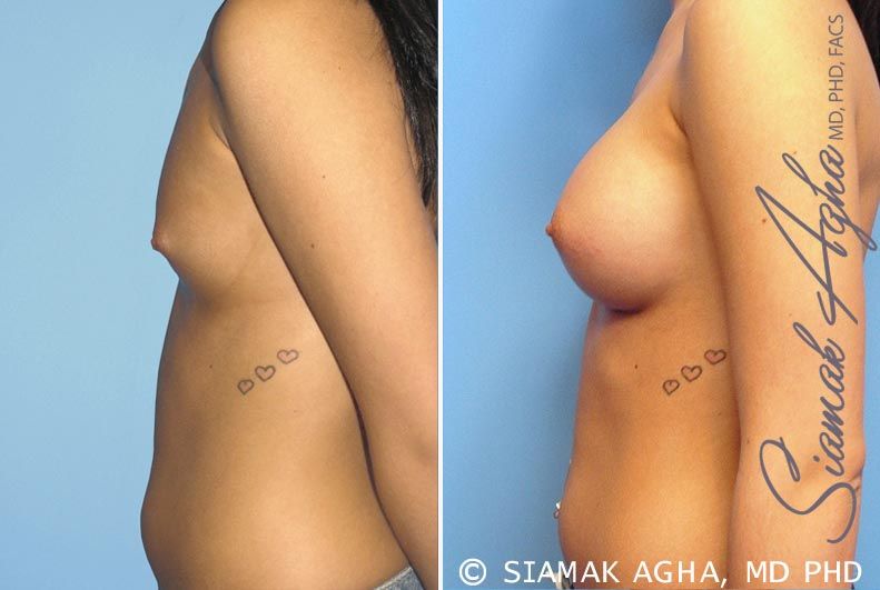Breast Augmentation Before & After