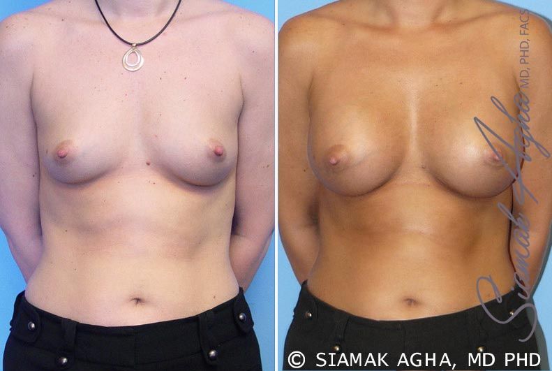 Breast Augmentation Before & After