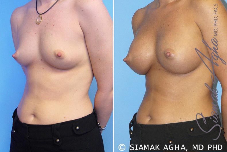 Breast Augmentation Before & After