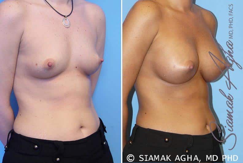 Breast Augmentation Before & After