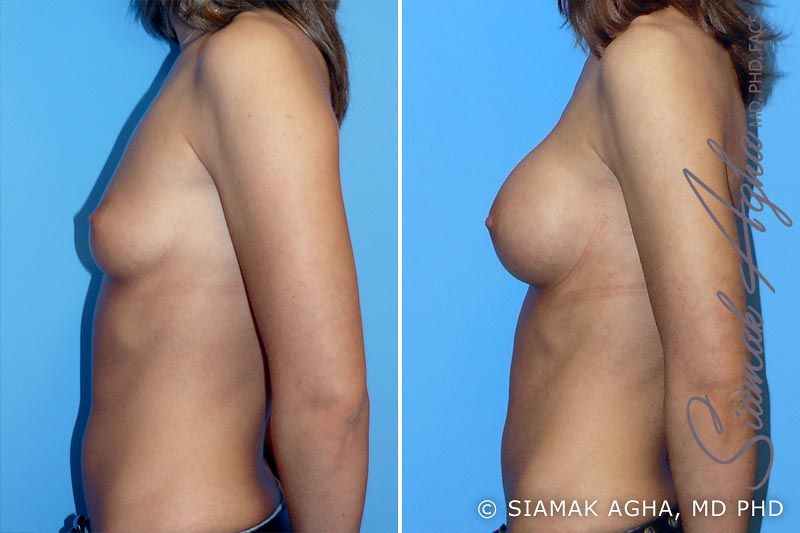Breast Augmentation Before & After
