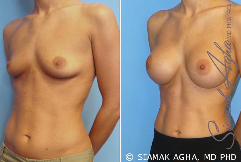 Breast Augmentation Before & After