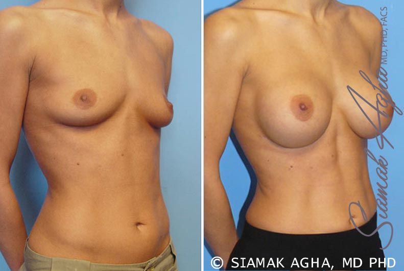 Breast Augmentation Before & After