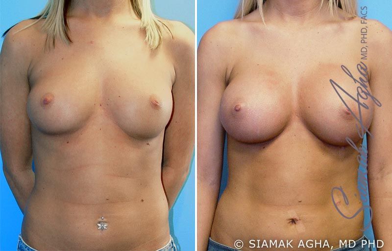 Breast Augmentation Before & After