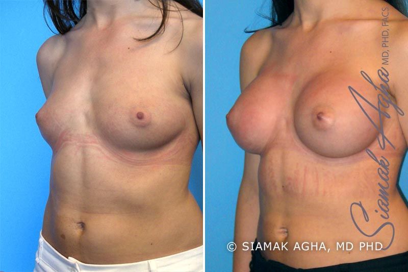 Breast Augmentation Before & After