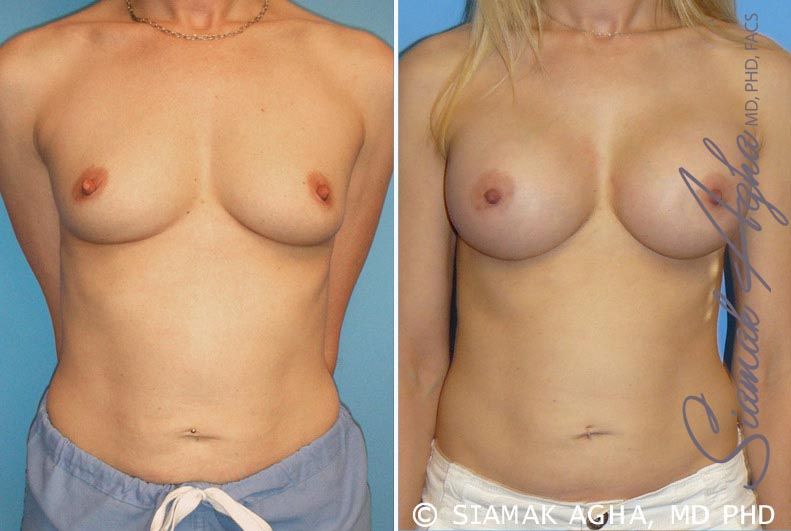 Breast Augmentation Before & After