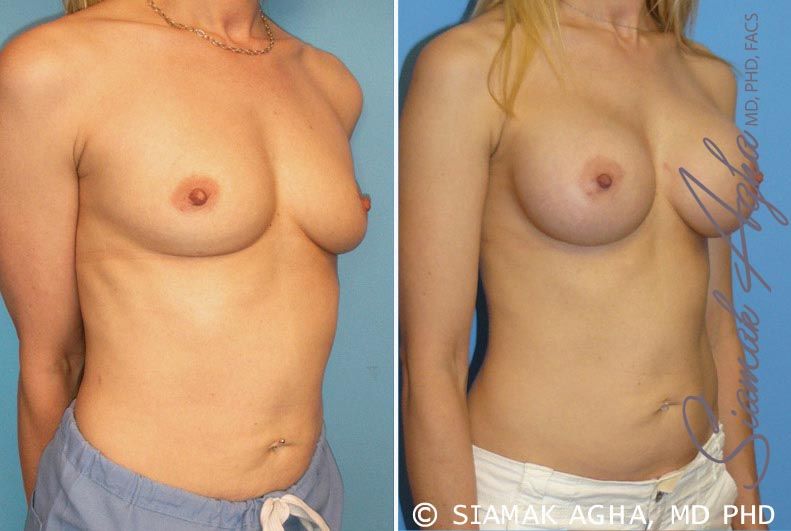 Breast Augmentation Before & After