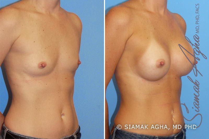 Breast Augmentation Before & After