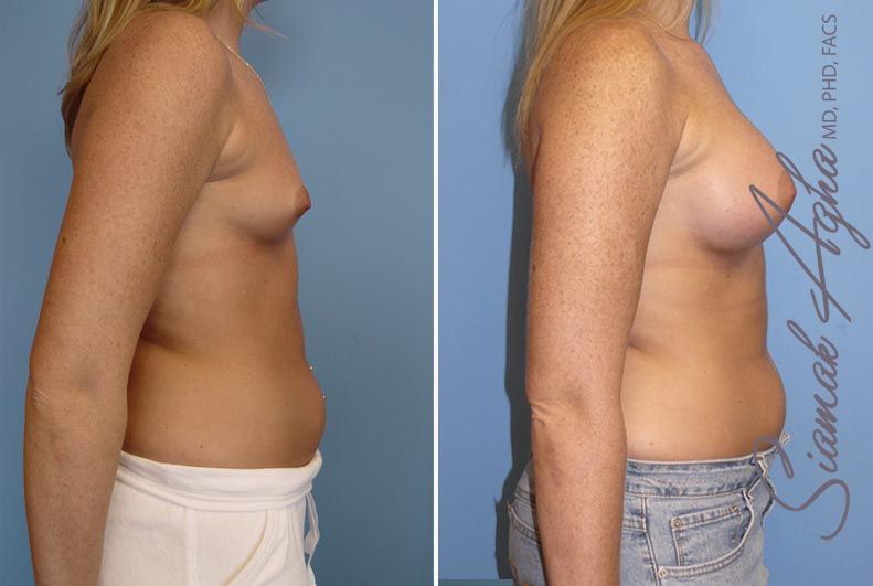 Breast Augmentation Before & After
