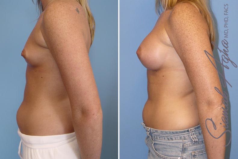 Breast Augmentation Before & After