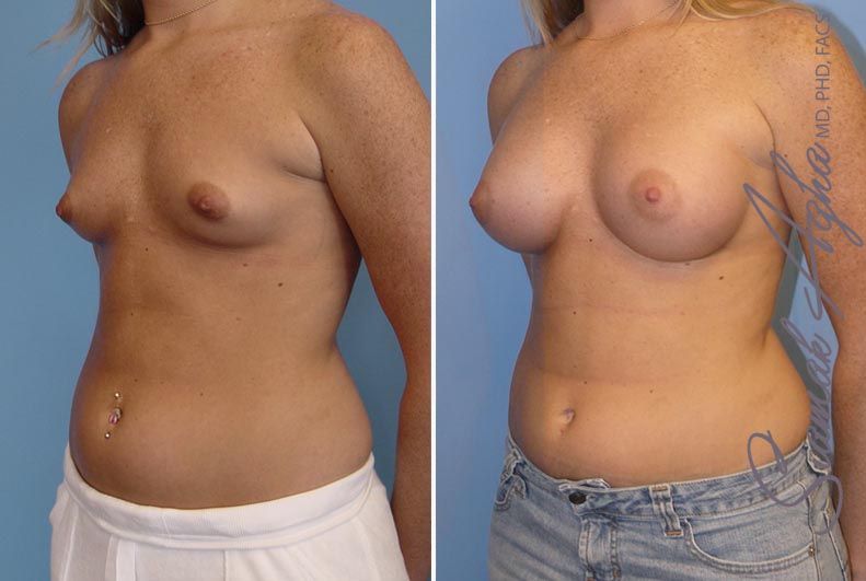 Breast Augmentation Before & After