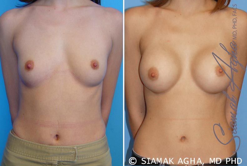 Breast Augmentation Before & After