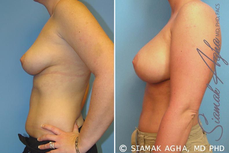 Breast Augmentation Before & After