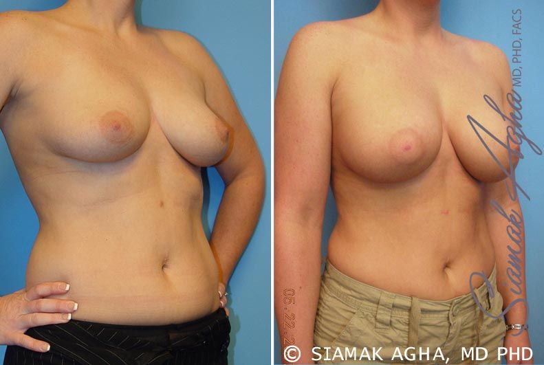 Breast Augmentation Before & After
