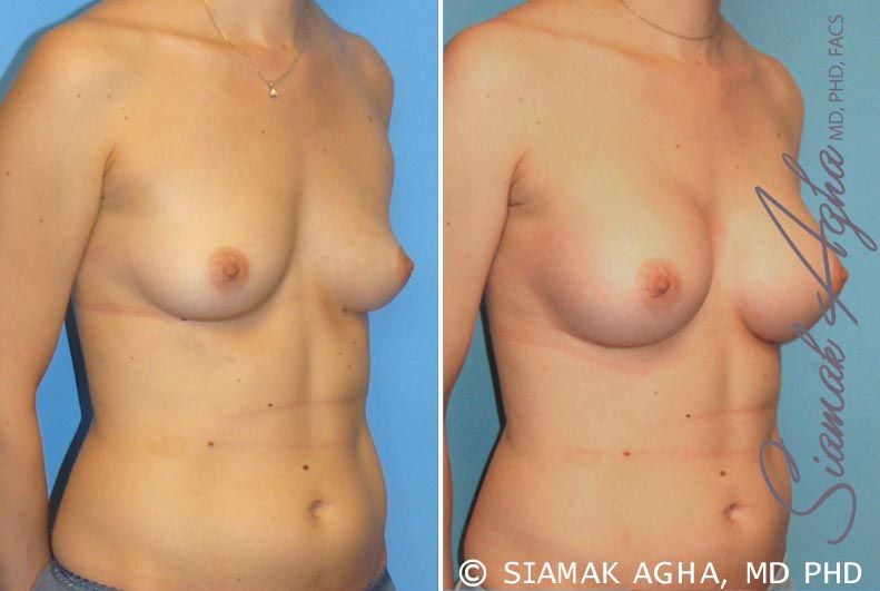 Breast Augmentation Before & After