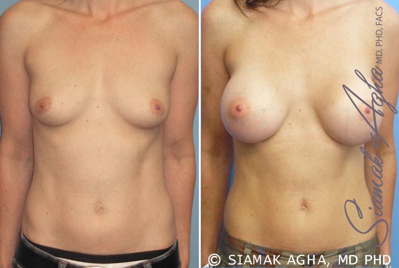 Breast Augmentation Before & After