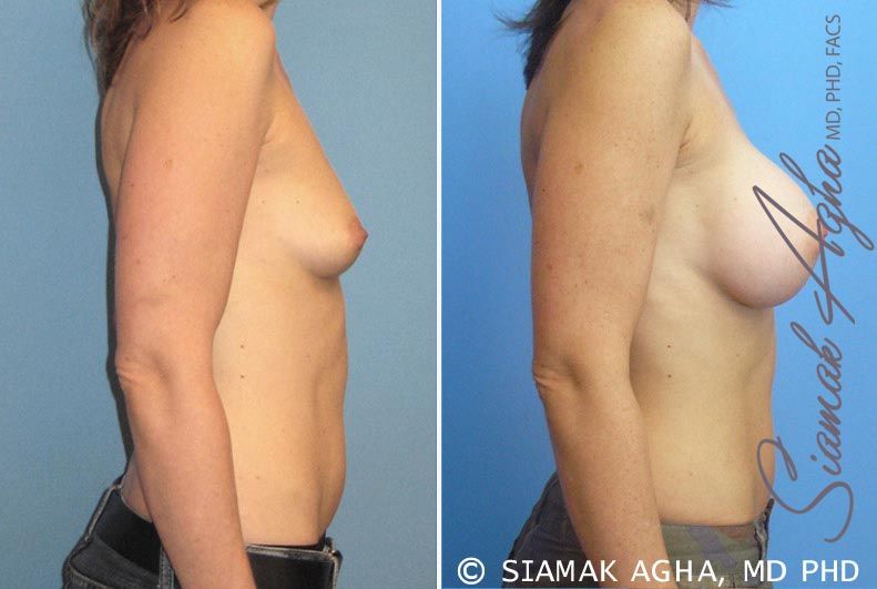 Breast Augmentation Before & After