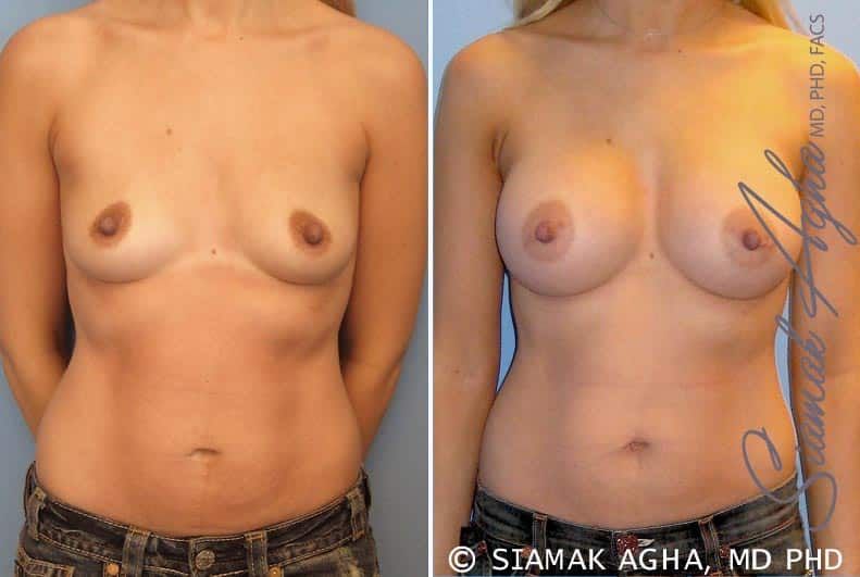 Breast Augmentation Before & After