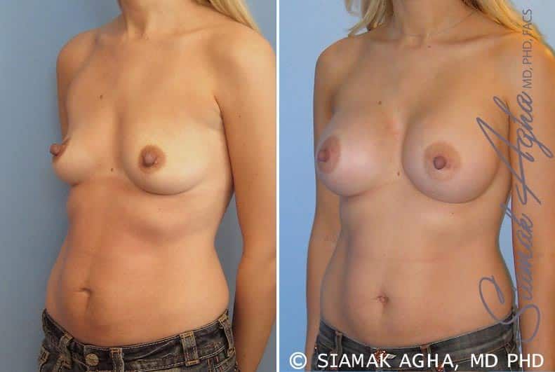 Breast Augmentation Before & After