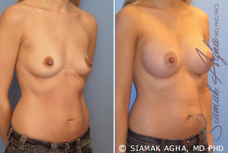 Breast Augmentation Before & After