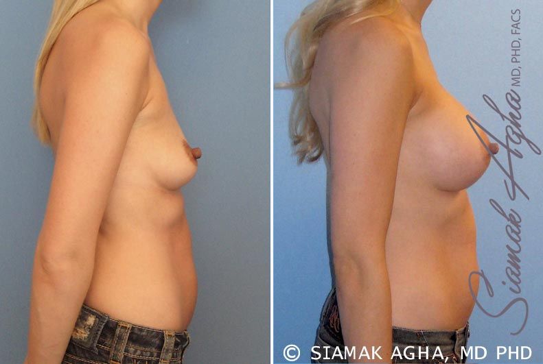 Breast Augmentation Before & After