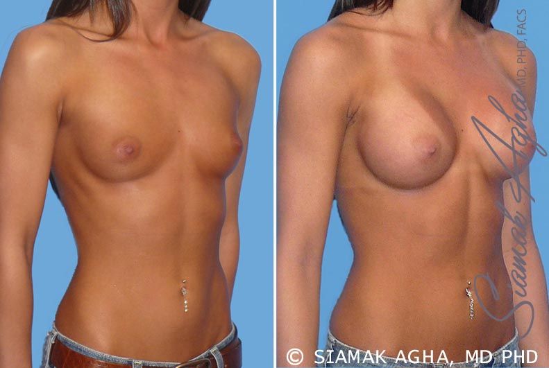 Breast Augmentation Before & After