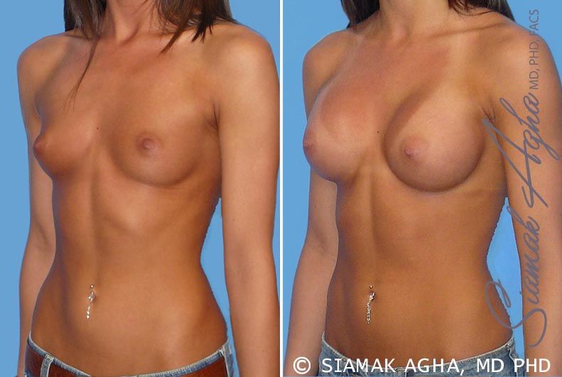 Breast Augmentation Before & After